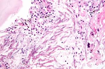 aspergillus pulmonary