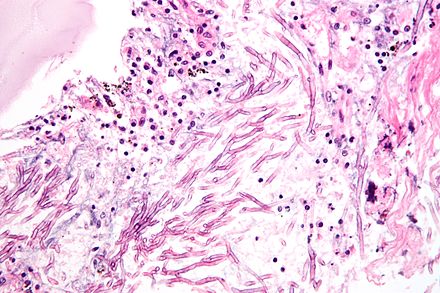 aspergillus pulmonary