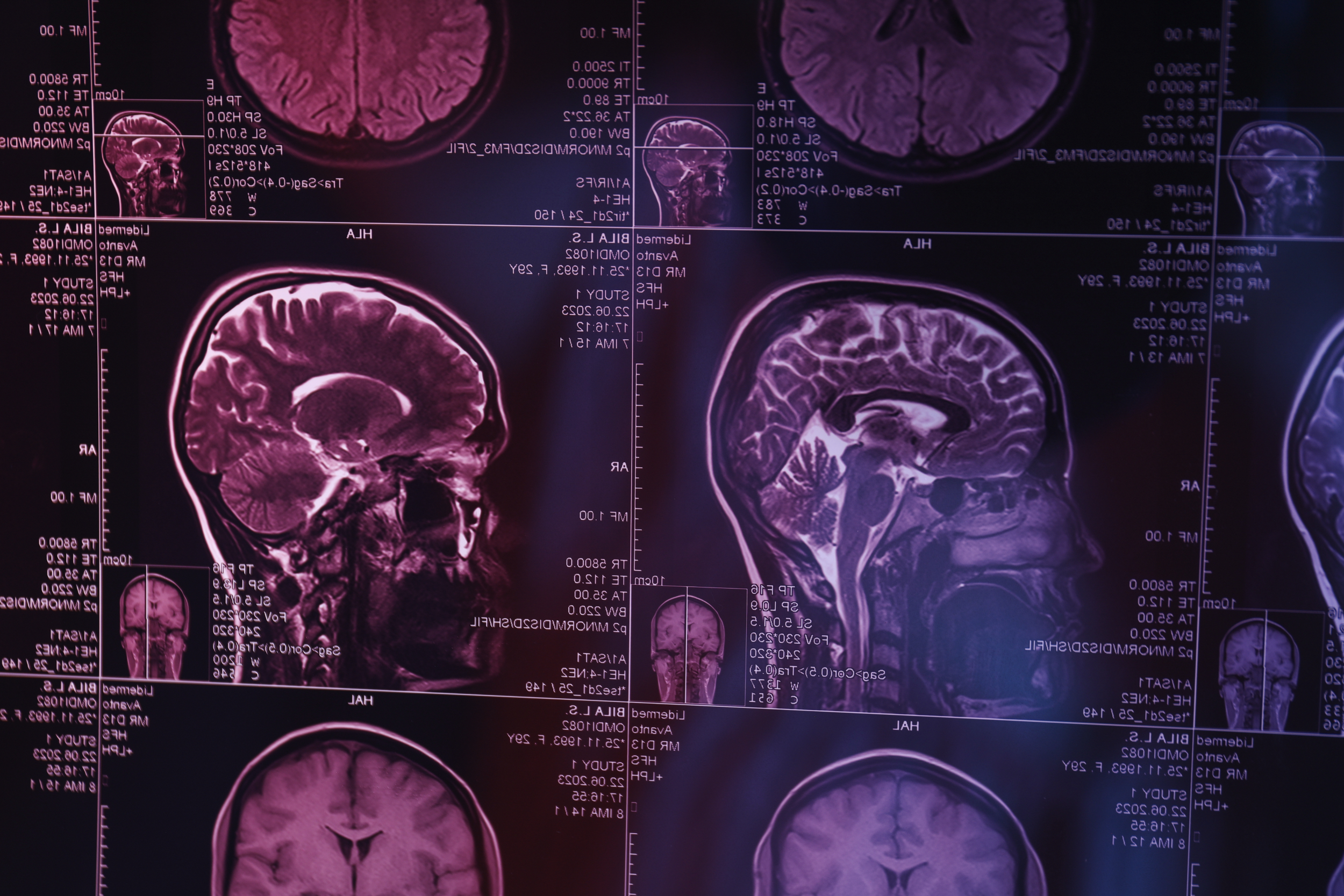 40Hz Alzheimer’s Therapy: Sound & Light Hope for Brain Health